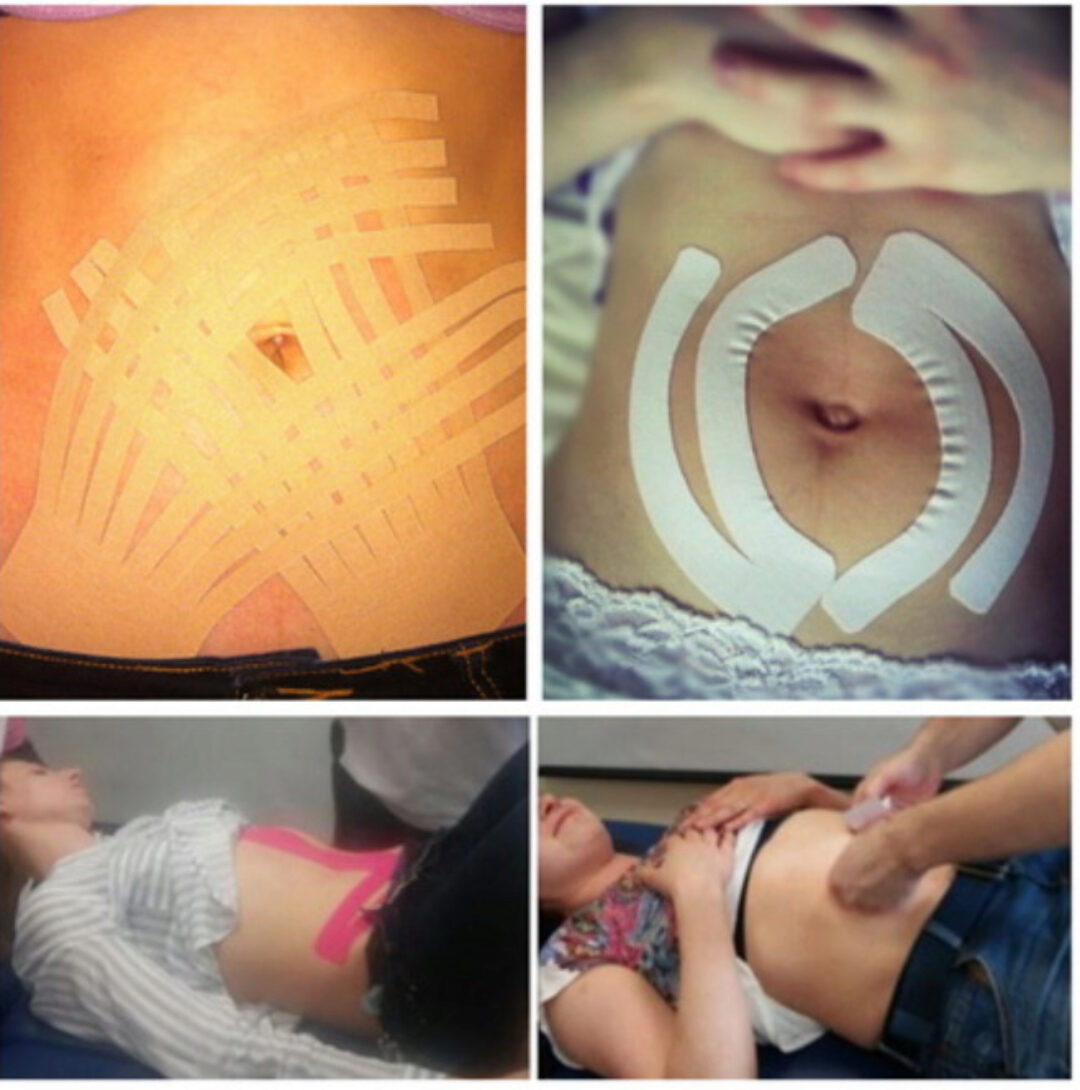 Использование кинезиотейпа при диастазе и слабости мышц живота (Дмитрий Горковский)