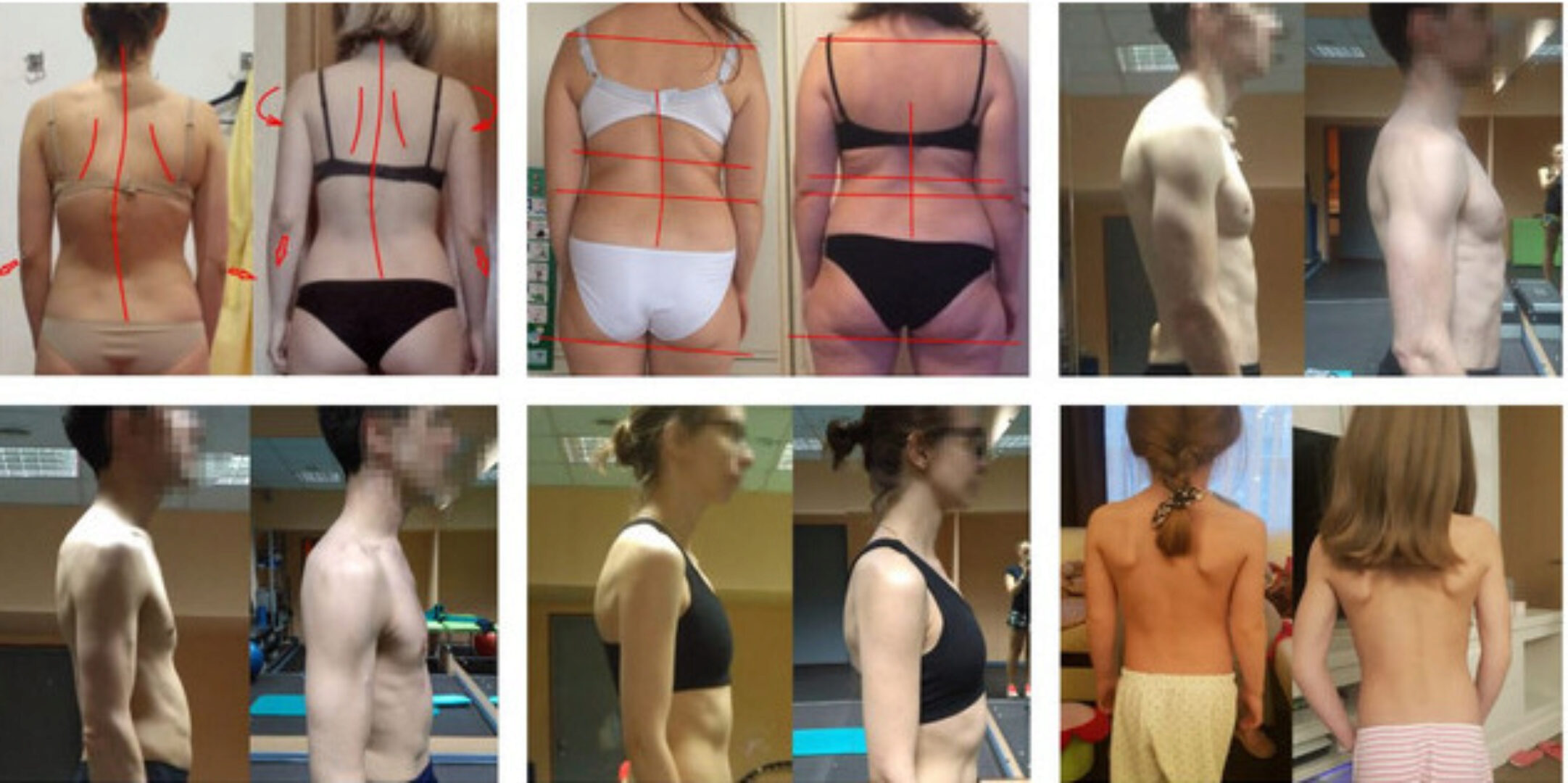 Распространенные проблемы ОДА: диагностика и коррекция (Ольга Бурова)