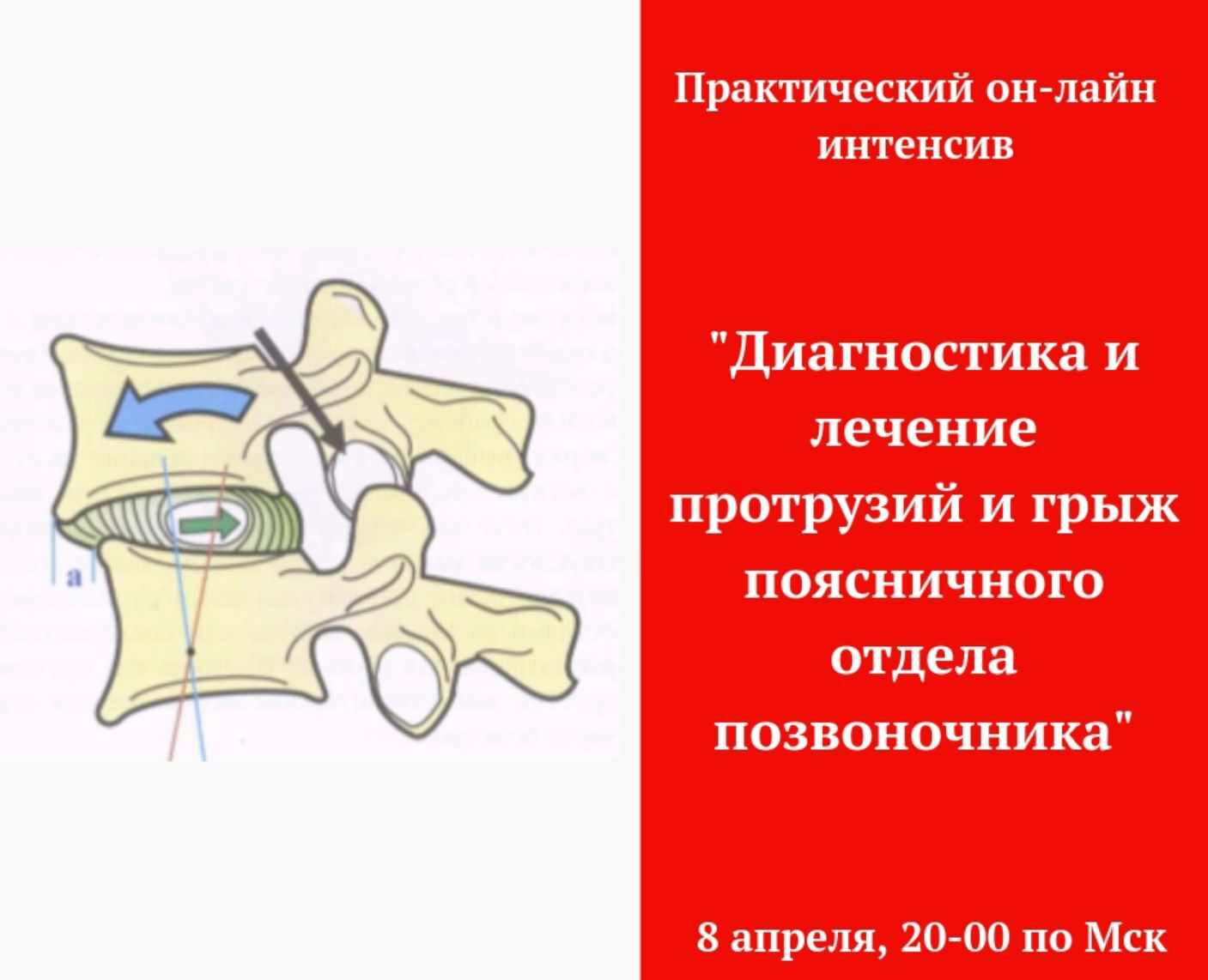 Диагностика и лечение грыж поясничного отдела (Игорь Атрощенко)