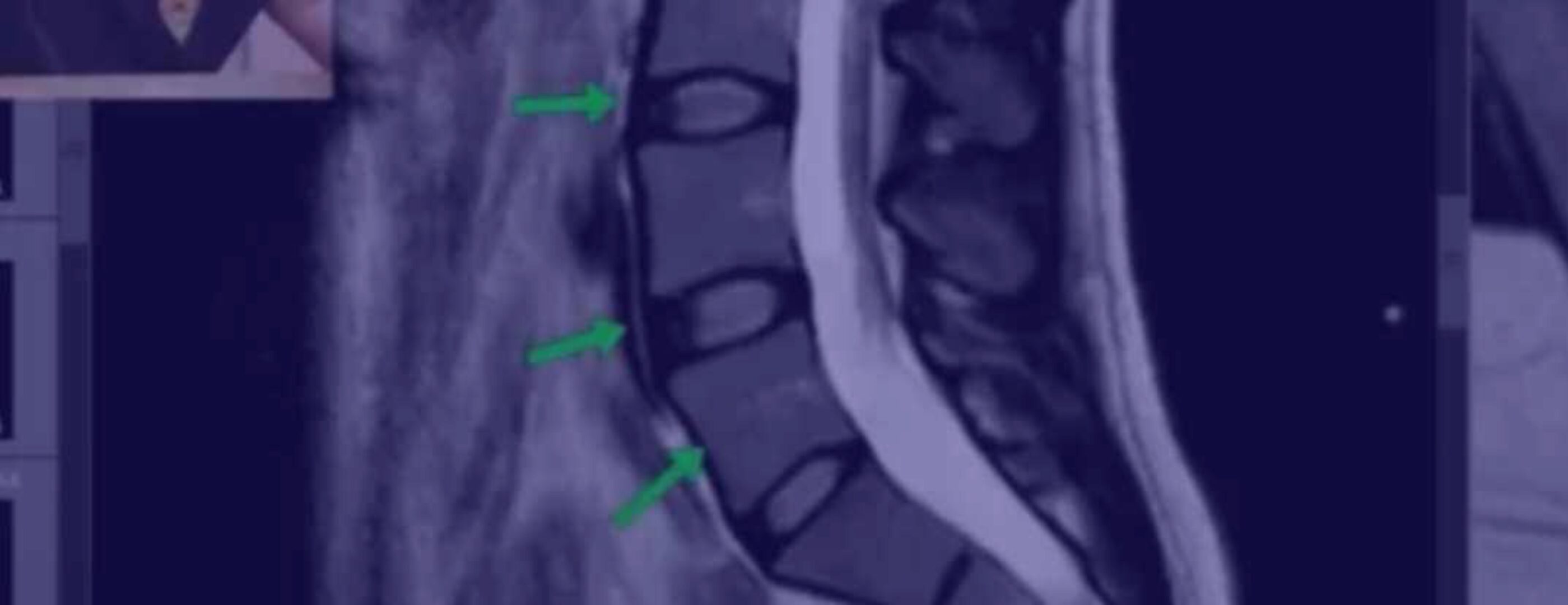 [Доктор Епифанов] Как читать МРТ поясницы, две части (Антон Епифанов)