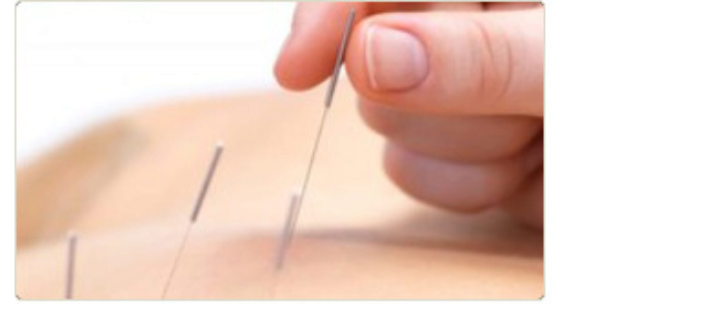 [Udemy]Иглотерапия для триггерных точек (Карелиадис Александрос)