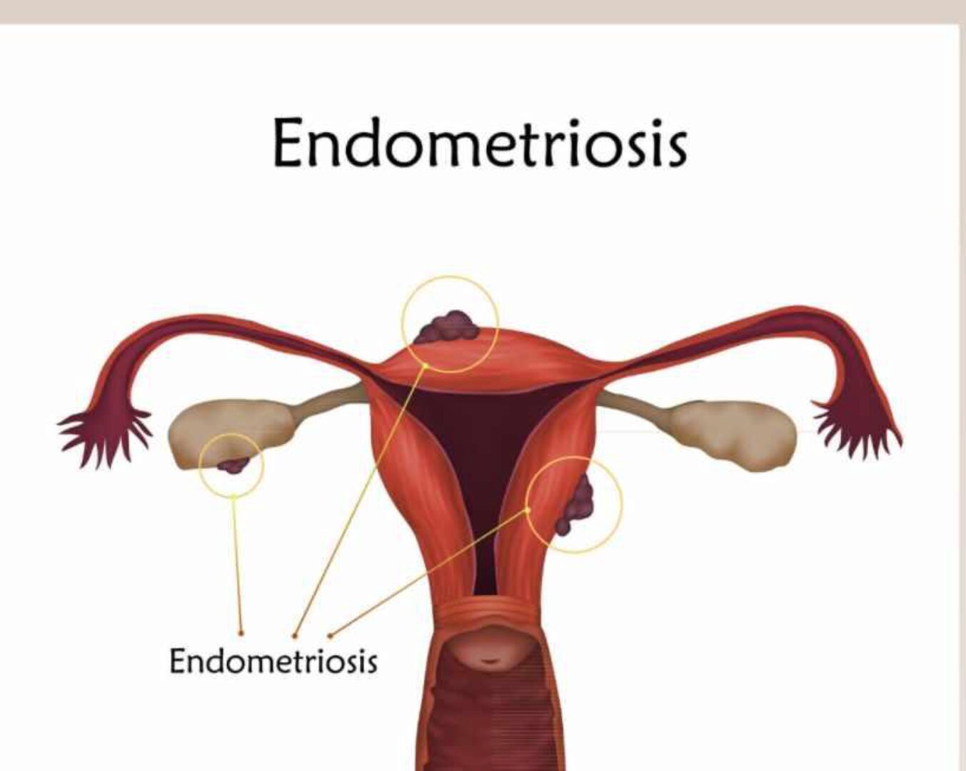 Проект «Эндометриоз» (Юлия Шефова)