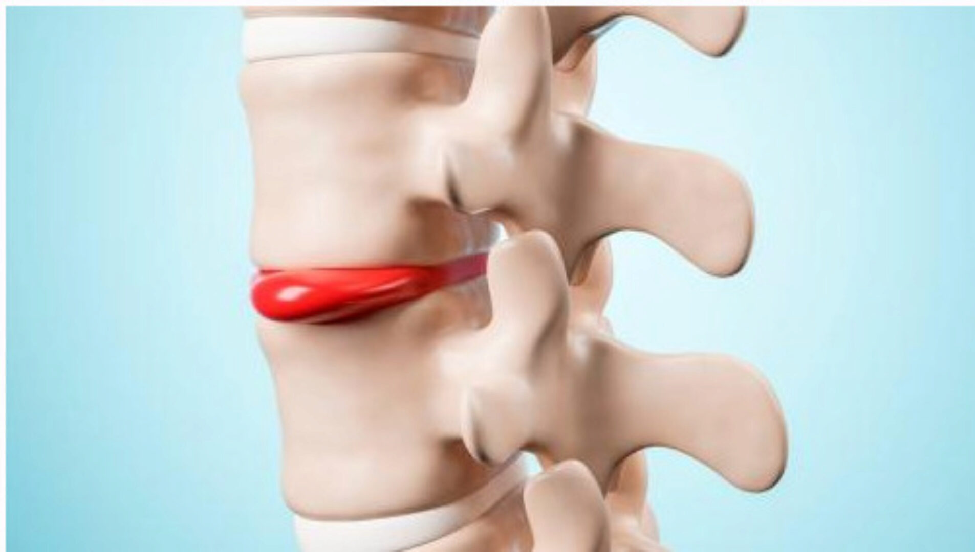 [Wellcom] Реабилитационный фитнес при межпозвонковых грыжах (Эльмира Хабибуллина)