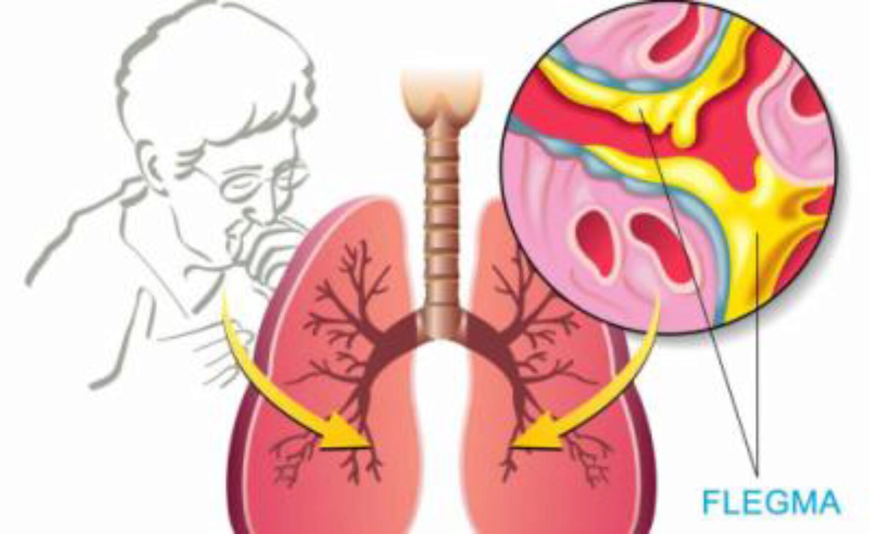 Выведение патологической жидкости. Сырость. Мокрота. Флегма 2014 (Лада Боровикова)