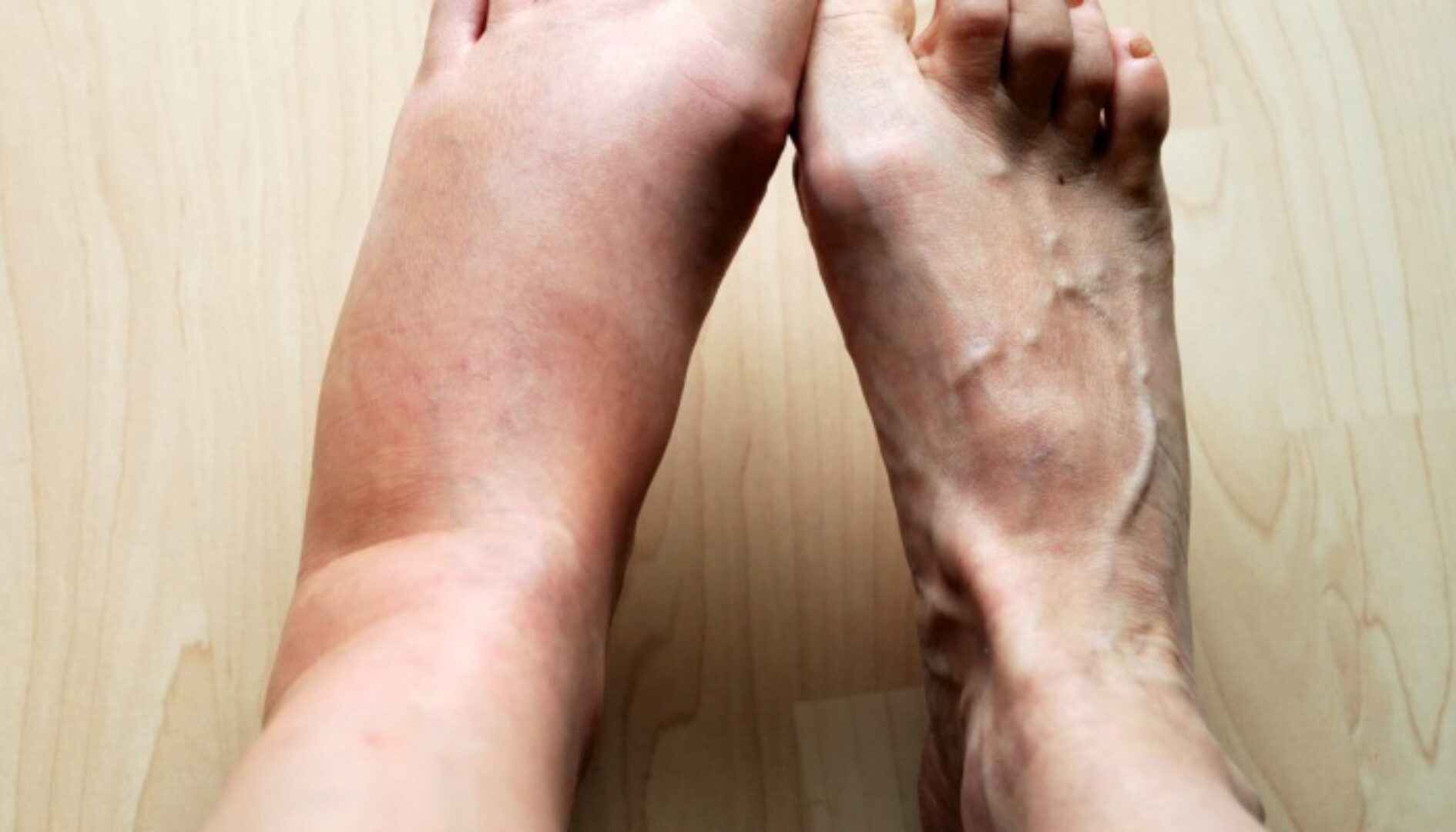 Отёчный синдром как диагностический маркёр патологических состояний (Екатерина Пигарова)