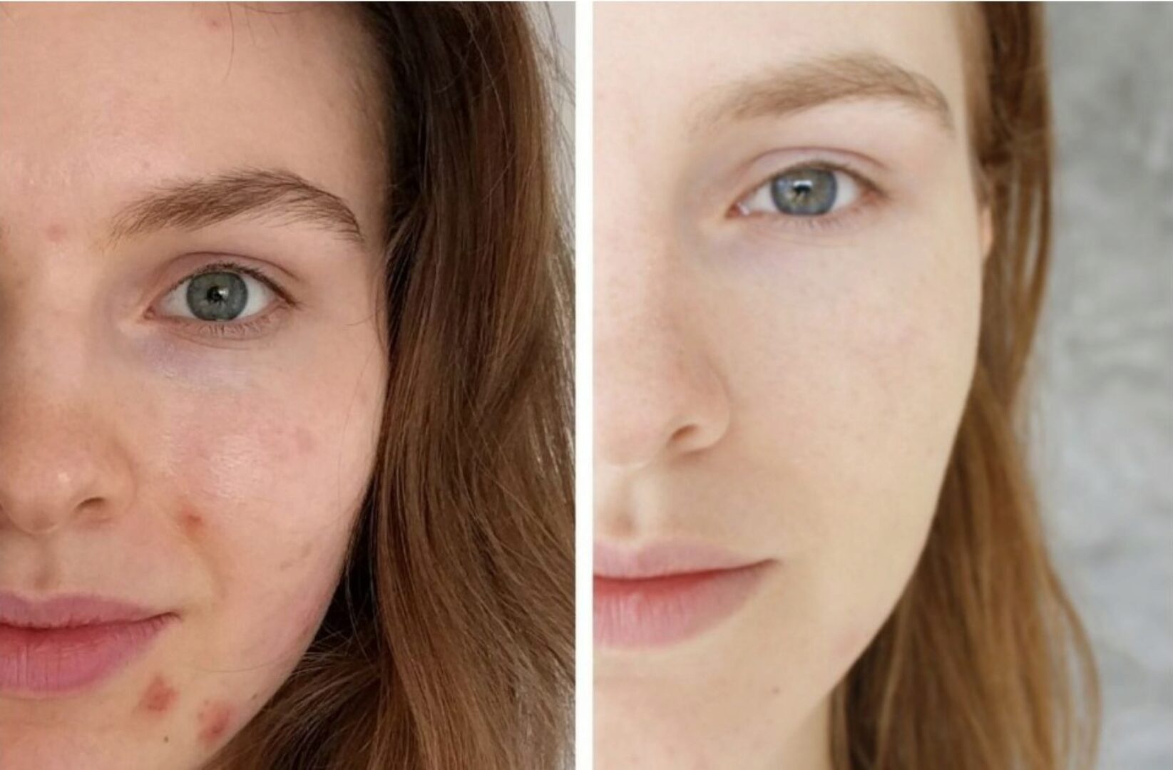 Курс по уходу за проблемной кожей «Анти-акне» (Яна Смирнова)