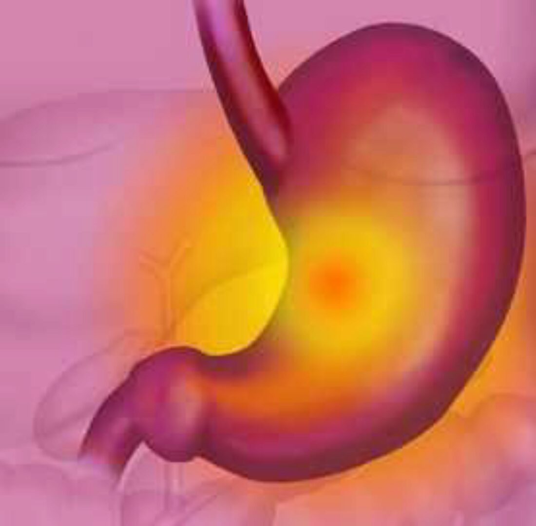 Коррекция желудка (Юджиния Квант)