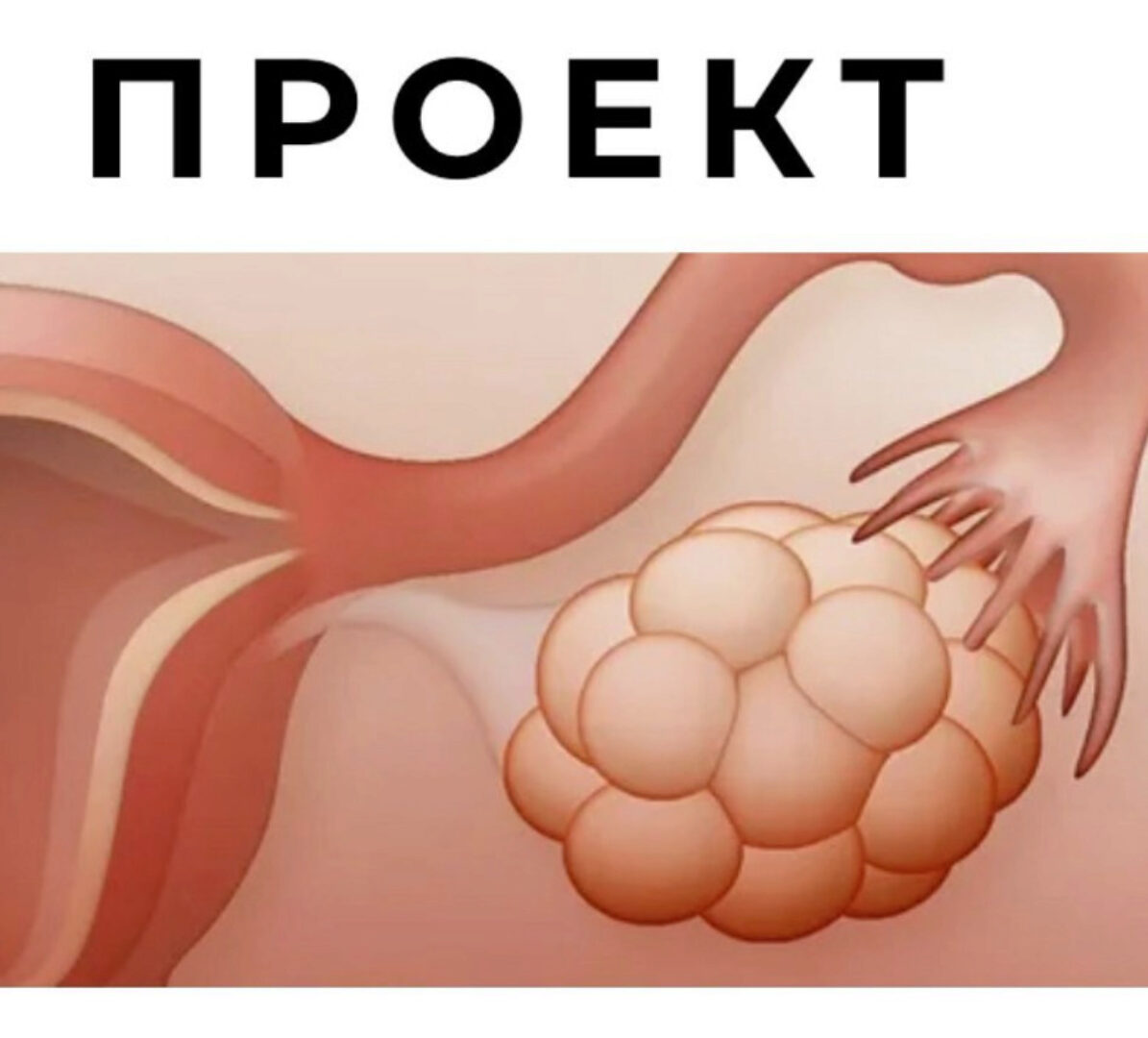 Спкя и другие нарушения менструального цикла (Гала Гарбузова)