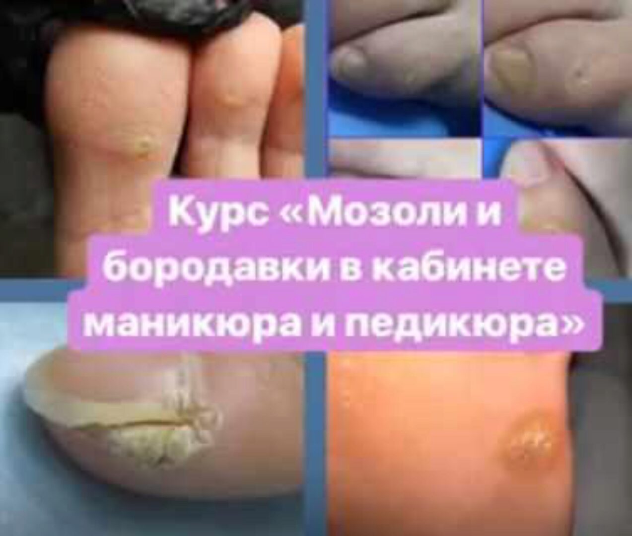 Мозоли и бородавки в кабинете маникюра и педикюра (Агата Черная)