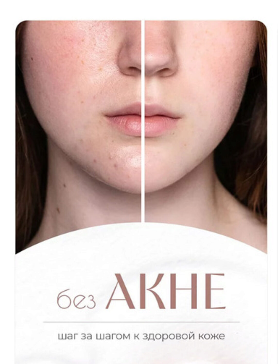 [dr_mashkina] БезАкне (Ксения Машкина)