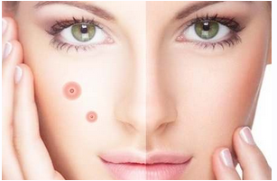 Как избавиться от прыщей и черных точек (Сергей Косарев)