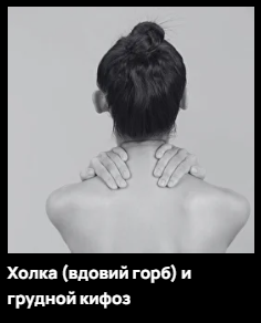 Холка - вдовий горб и грудной кифоз (Александр Волоткевич)